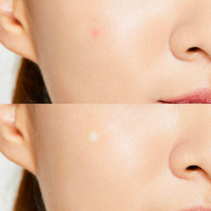 Acne Pimple Master Patch